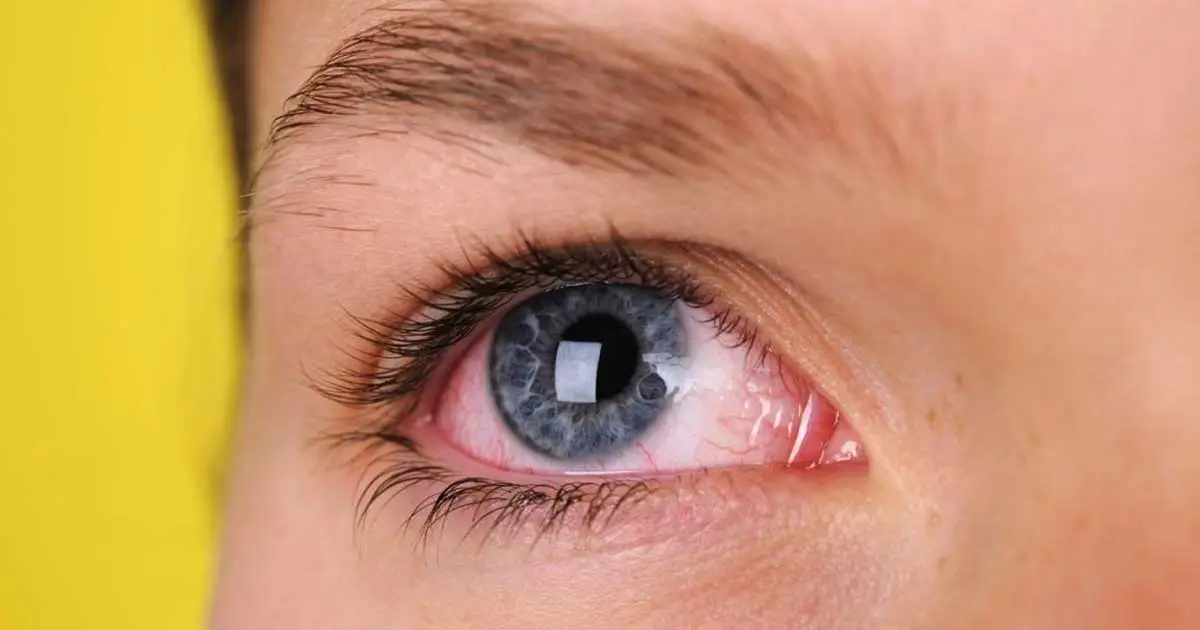 conjuntivitis.webp